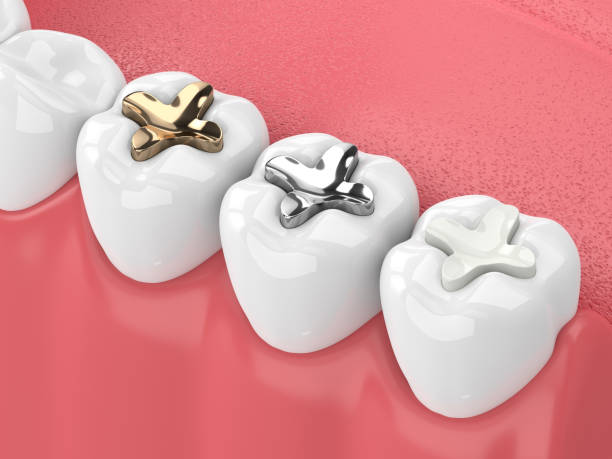 Tooth Fillings (Composite, Amalgam)